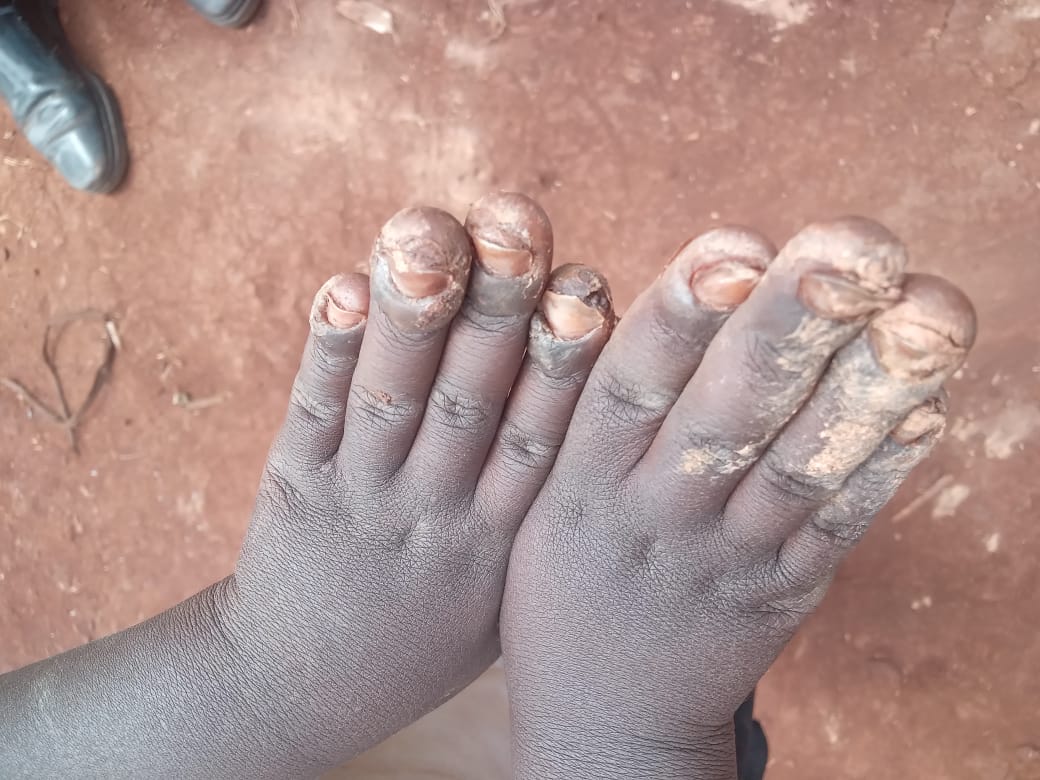 Jiggers Eradication at Gekomoni Village